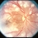 SLE Vasculitis